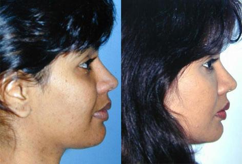 Rhinoplasty before and after photos in San Francisco, CA, Patient 13466