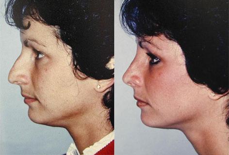 Rhinoplasty before and after photos in San Francisco, CA, Patient 13471