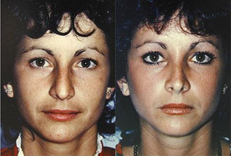 Rhinoplasty before and after photos in San Francisco, CA, Patient 13471