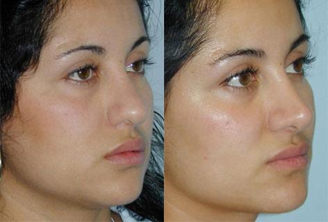 Rhinoplasty before and after photos in San Francisco, CA, Patient 13476