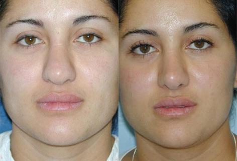 Rhinoplasty before and after photos in San Francisco, CA, Patient 13476
