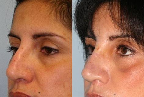 Rhinoplasty before and after photos in San Francisco, CA, Patient 13483