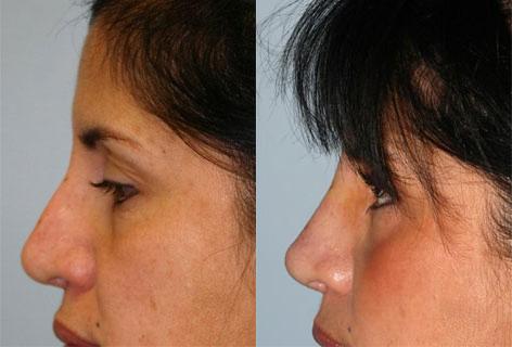 Rhinoplasty before and after photos in San Francisco, CA, Patient 13483