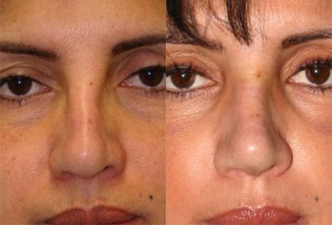 Rhinoplasty before and after photos in San Francisco, CA, Patient 13483