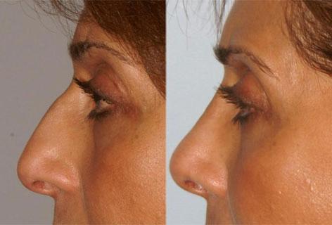 Rhinoplasty before and after photos in San Francisco, CA, Patient 13490