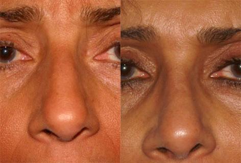 Rhinoplasty before and after photos in San Francisco, CA, Patient 13490