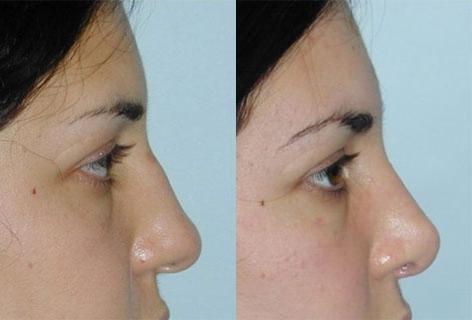 Rhinoplasty before and after photos in San Francisco, CA, Patient 13497