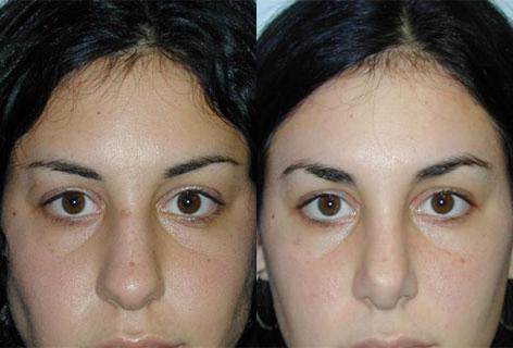 Rhinoplasty before and after photos in San Francisco, CA, Patient 13497