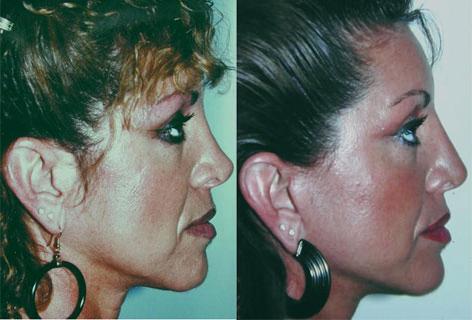 Rhinoplasty before and after photos in San Francisco, CA, Patient 13502