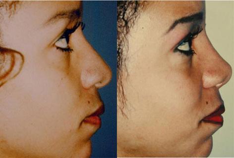 Rhinoplasty before and after photos in San Francisco, CA, Patient 13507