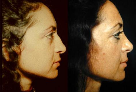 Rhinoplasty before and after photos in San Francisco, CA, Patient 13512