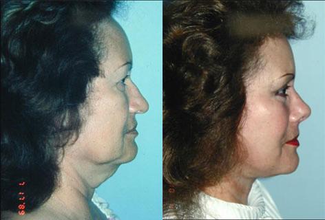 Rhinoplasty before and after photos in San Francisco, CA, Patient 13515