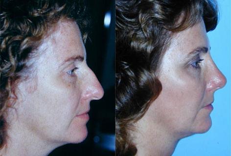 Rhinoplasty before and after photos in San Francisco, CA, Patient 13521