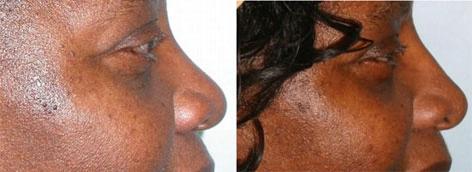 Rhinoplasty before and after photos in San Francisco, CA, Patient 13524