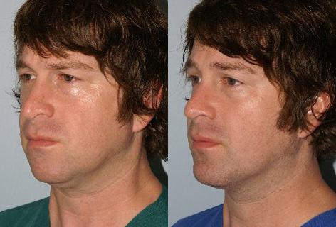 Patient 13532, Rhinoplasty before and after photos Rhinoplasty before and after photos in San Francisco, CA, Patient 13532