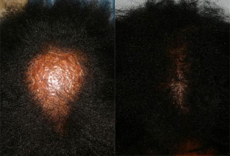 Hair Reconstructive Scalp before and after photos in San Francisco, CA, Patient 13827