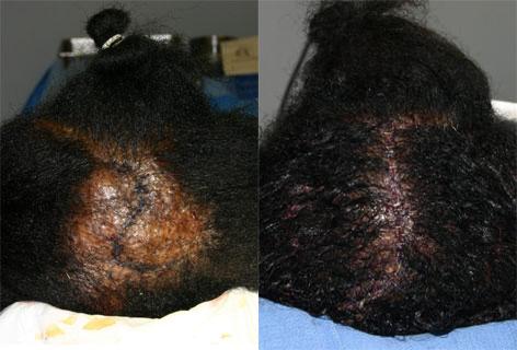 Hair Reconstructive Scalp before and after photos in San Francisco, CA, Patient 13827