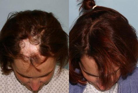 Hair Reconstructive Scalp before and after photos in San Francisco, CA, Patient 13832