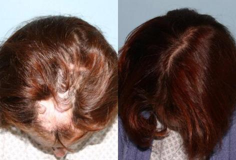 Hair Reconstructive Scalp before and after photos in San Francisco, CA, Patient 13832