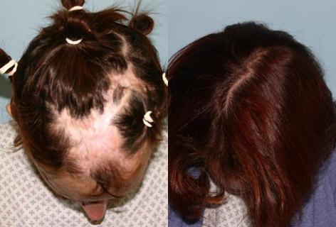 Hair Reconstructive Scalp before and after photos in San Francisco, CA, Patient 13832