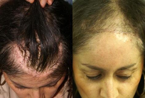 Hair Reconstructive Scalp before and after photos in San Francisco, CA, Patient 13852