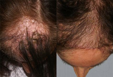 Hair Reconstructive Scalp before and after photos in San Francisco, CA, Patient 13852