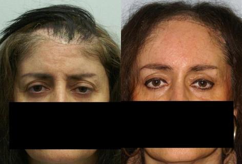 Hair Reconstructive Scalp before and after photos in San Francisco, CA, Patient 13852