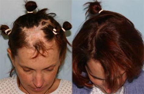 Hair Reconstructive Scalp before and after photos in San Francisco, CA, Patient 13875