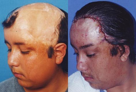 Hair Reconstructive Scalp before and after photos in San Francisco, CA, Patient 13878