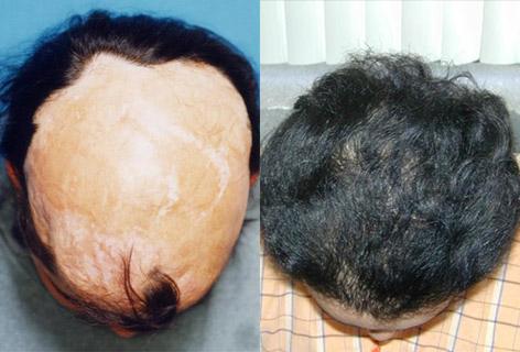 Hair Reconstructive Scalp before and after photos in San Francisco, CA, Patient 13878