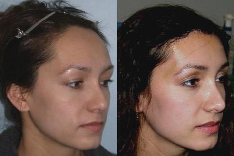 Hair Line Lowering before and after photos in San Francisco, CA, Patient 13925