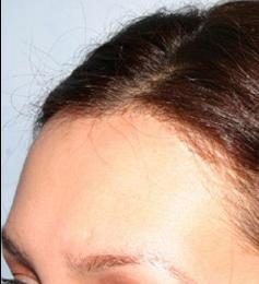 Hair Line Lowering before and after photos in San Francisco, CA, Patient 13925