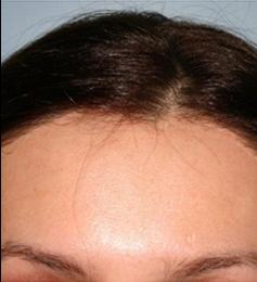 Hair Line Lowering before and after photos in San Francisco, CA, Patient 13925