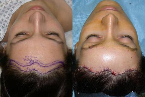 Hair Line Lowering before and after photos in San Francisco, CA, Patient 13925