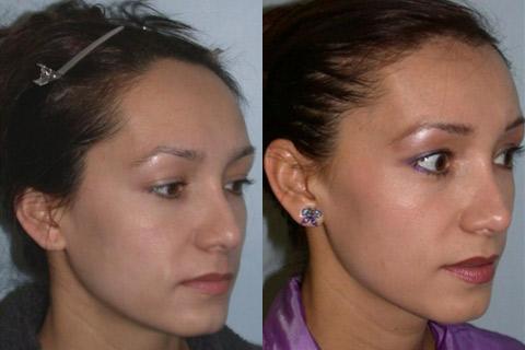 Hair Line Lowering before and after photos in San Francisco, CA, Patient 13925