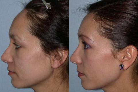 Hair Line Lowering before and after photos in San Francisco, CA, Patient 13925