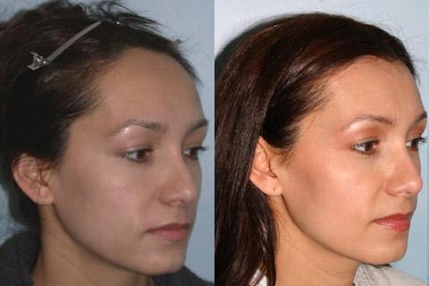 Hair Line Lowering before and after photos in San Francisco, CA, Patient 13925