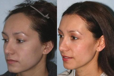 Hair Line Lowering before and after photos in San Francisco, CA, Patient 13925