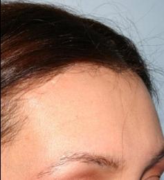 Hair Line Lowering before and after photos in San Francisco, CA, Patient 13925