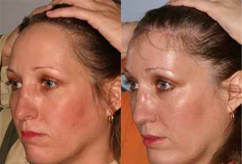 Hair Line Lowering before and after photos in San Francisco, CA, Patient 13936