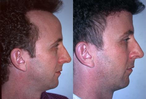 Hair Line Lowering before and after photos in San Francisco, CA, Patient 13941