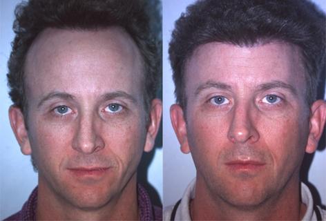 Hair Line Lowering before and after photos in San Francisco, CA, Patient 13941