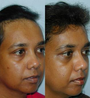 Hair Line Lowering before and after photos in San Francisco, CA, Patient 13946