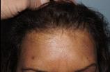 Hair Line Lowering before and after photos in San Francisco, CA, Patient 13946