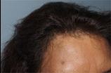 Hair Line Lowering before and after photos in San Francisco, CA, Patient 13946