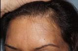 Hair Line Lowering before and after photos in San Francisco, CA, Patient 13946