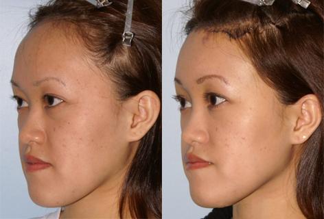 Hair Line Lowering before and after photos in San Francisco, CA, Patient 13951