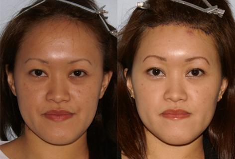 Hair Line Lowering before and after photos in San Francisco, CA, Patient 13951