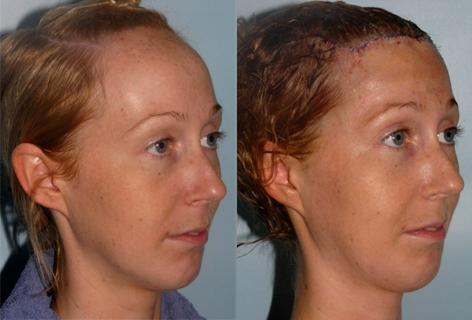 Hair Line Lowering before and after photos in San Francisco, CA, Patient 13963