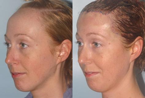 Hair Line Lowering before and after photos in San Francisco, CA, Patient 13963